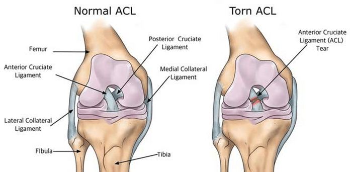 A picture of a normal and torn ACL.