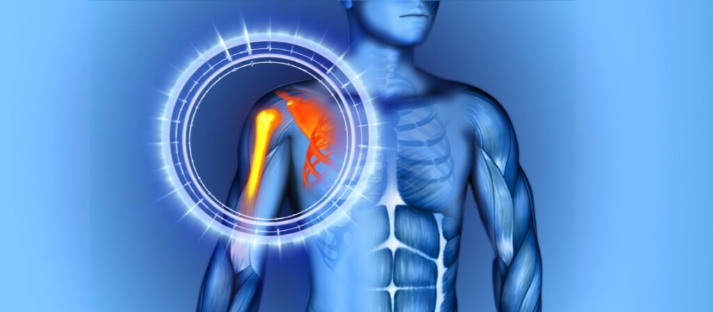 Is Shoulder Arthroplasty Right for You? What Patients Need to Know 1 3D illustration highlighting shoulder joint pain.